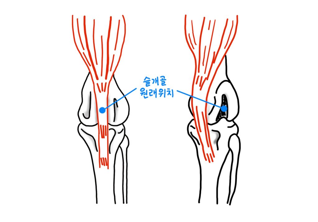 강아지 슬개골 탈구 증상 - 슬개골 탈구 설명